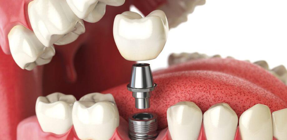 Implant Guide Nedir?